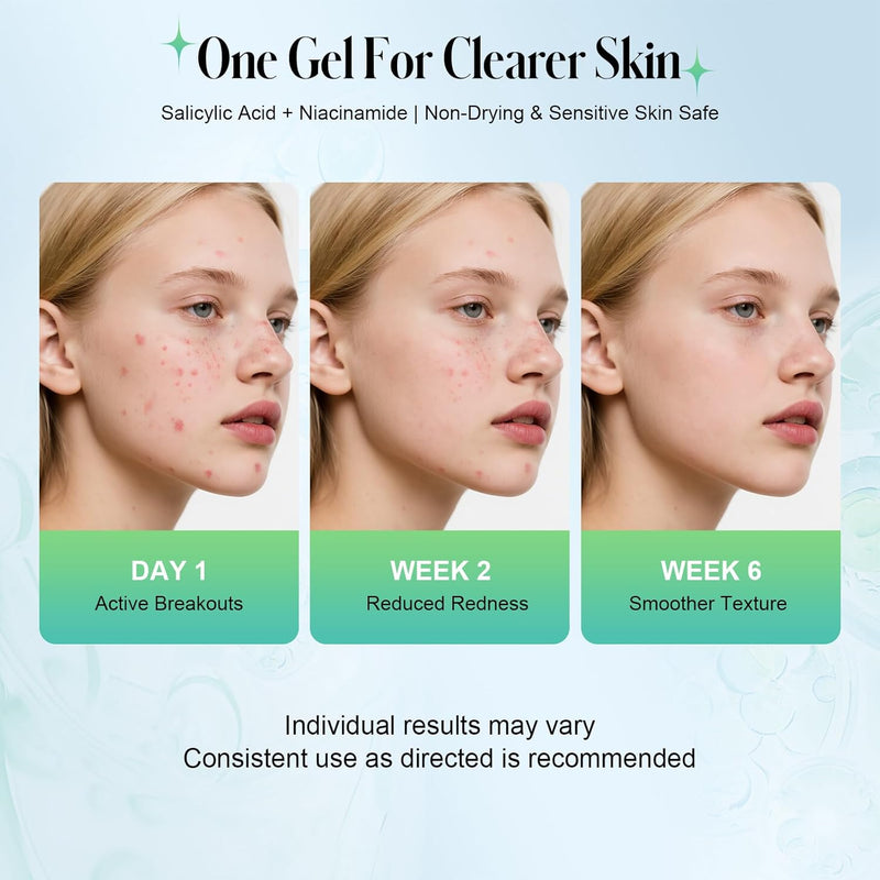 Salicylic Acid Spot Treatment Gel – 2% BHA Acne Treatment for Face, Helps Clear Breakouts & Blackheads, Oil-Free & Non-Irritating Formula, 0.35 Fl Oz Infinity Warehouse