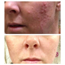 Glycolic Acid 40% (Professional Chemical Peel) Pro Strength Alpha Hydroxy Acid Skin Peel - Intense Anti-Aging Treatment For Wrinkles, Fine Lines, Brown Spots, and Acne Scarring - Beauty Coquette