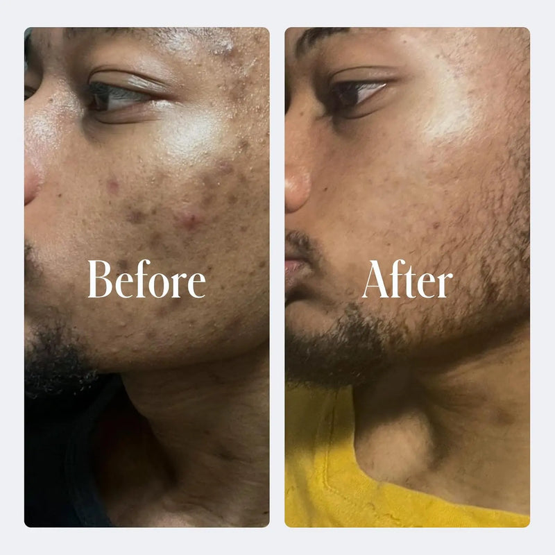 Geologie Complete Skincare Set for Men & Women | 3-Month Simple & Effective Daily Clear Skin Routine | Acne, Oily Skin, Dark Spots | Face Wash 2-Pack, Retinol Face Cream, SPF15 Moisturizer & Eye Cream Infinity Warehouse