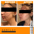 DRMTLGY Acne Spot Treatment and Cystic Acne Treatment. Acne Serum with Micronized Benzoyl Peroxide 5% and Glycolic Acid DRMTLGY