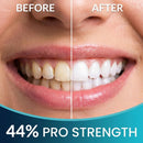 Teeth Whitening Gel with Trays 44% Carbamide Peroxide 5 Syringes - 50+ Uses Infinity Warehouse