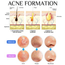 Teenitor Pimple Extractor Acne Treatment Tool Surgical Grade Blackhead Comedone Removal 2-In-1 Popper Tool For Face Nose Teenitor