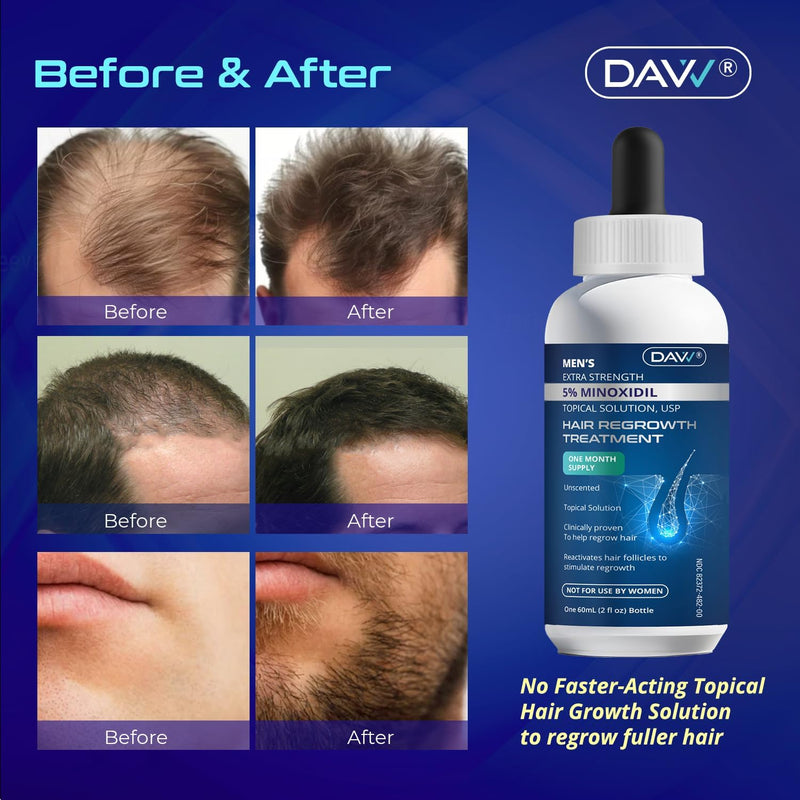 Minoxidil for Men Hair Growth Serum: Minoxidil 5 Percent - Hair Regrowth for Men - Minoxidil for Beard Growth - Hair Loss Treatments - Minoxidil 5% - Faster Thicker Stronger Hair Growth - 60ml Infinity Warehouse