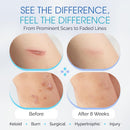Medical Grade Silicone Scar Sheets - 7" Reusable Water-Resistant Silicone Tape for Scars - Clear Breathable Tape for C-Section, Tummy Tuck, Surgical Scars, and Keloids - 4-Pack Infinity Warehouse