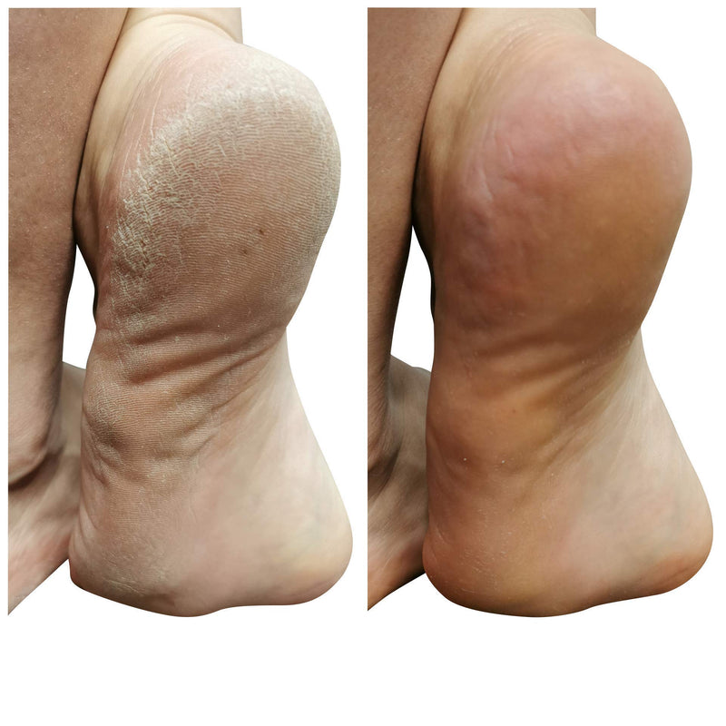 Lee Beauty Professional Callus Remover Extra Strength Gel for Feet, at Home Pedicure Results, 8 Oz LeeBeauty Professional