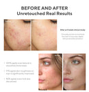 Murad InvisiScar Resurfacing Treatment for reducing the appearance of Acne Scars and Dark Spots, 0.5 Fl Oz Murad