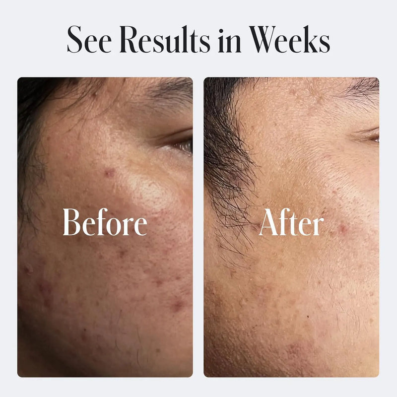 Geologie Skin Repair Moisturizer Face Cream | Clear System Retinol Resurfacing Formula | For Acne Prone Skin with Niacinamide & Hyaluronic Acid | Clears & Repairs Skin | 60 ML Infinity Warehouse