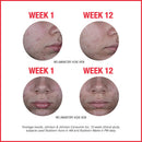 Neutrogena Stubborn Acne AM Face Treatment with 2.5% Micronized Benzoyl Peroxide Acne Medicine, Oil-Free Daily Facial Treatment to Reduce Size & Redness of Breakouts, Paraben-Free, 2 oz Neutrogena