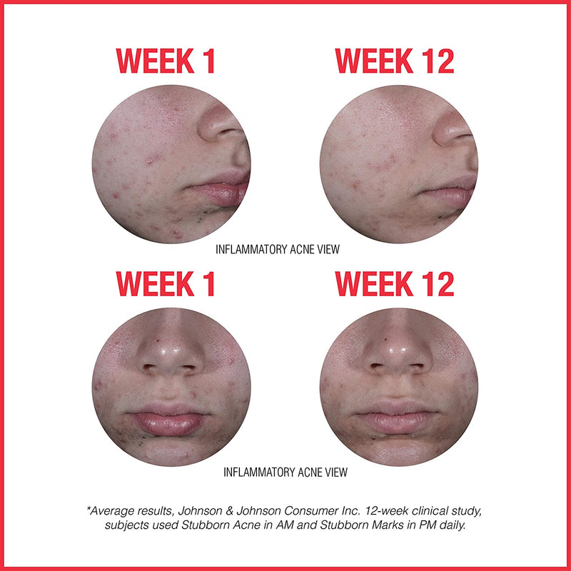 Neutrogena Stubborn Acne AM Face Treatment with 2.5% Micronized Benzoyl Peroxide Acne Medicine, Oil-Free Daily Facial Treatment to Reduce Size & Redness of Breakouts, Paraben-Free, 2 oz Neutrogena