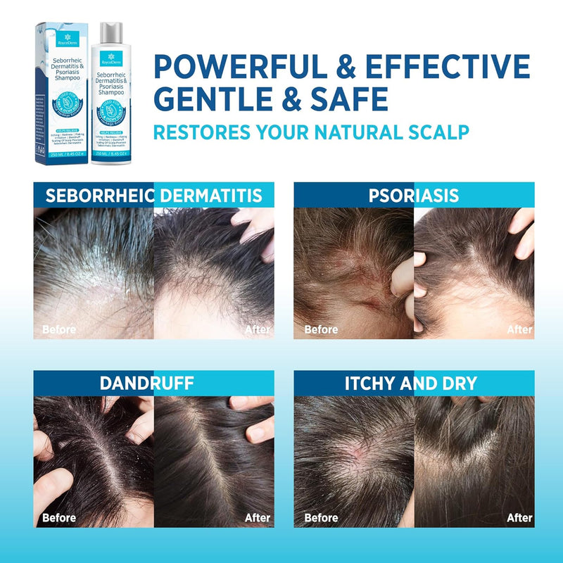Roycederm Seborrheic Dermatitis & Psoriasis Shampoo and Conditioner Set - Effective Scalp Treatment for Folliculitis, Psoriasis, Dandruff, Dry Itchy Scalp - Soothing, Moisturizing Herbal Formula Infinity Warehouse