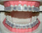 Tecnidentusa Clip-On Comfort Lip Shield/Mouth Protector Guard for Braces Dental Wax Alternative TecnidentUSA Affordable Quality Orthodontics Suppliers
