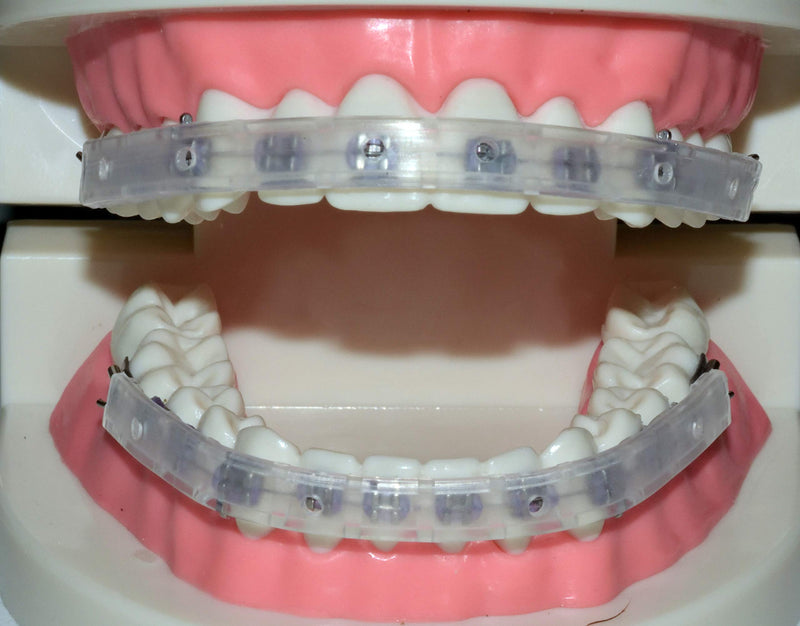Tecnidentusa Clip-On Comfort Lip Shield/Mouth Protector Guard for Braces Dental Wax Alternative TecnidentUSA Affordable Quality Orthodontics Suppliers