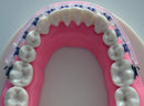 Tecnidentusa Clip-On Comfort Lip Shield/Mouth Protector Guard for Braces Dental Wax Alternative TecnidentUSA Affordable Quality Orthodontics Suppliers
