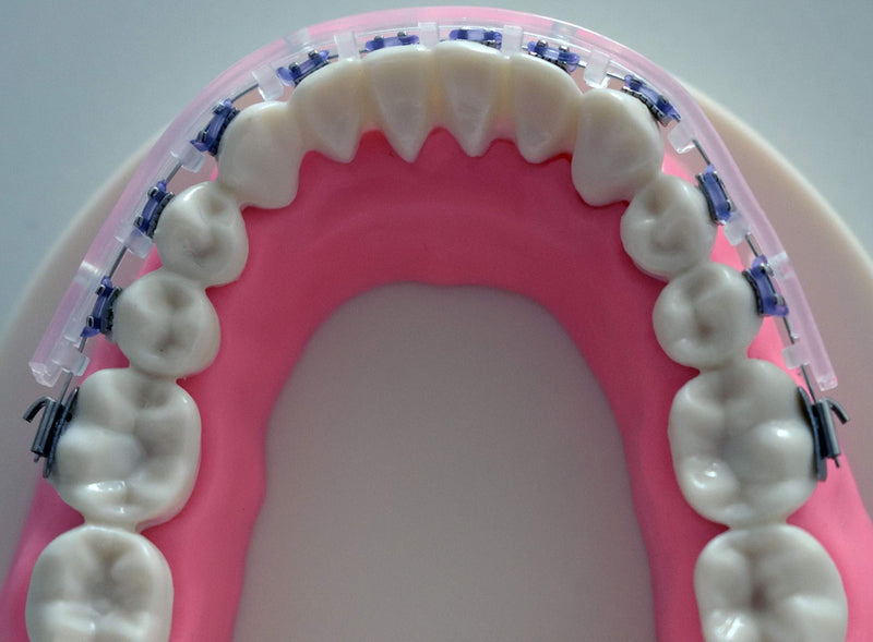 Tecnidentusa Clip-On Comfort Lip Shield/Mouth Protector Guard for Braces Dental Wax Alternative TecnidentUSA Affordable Quality Orthodontics Suppliers