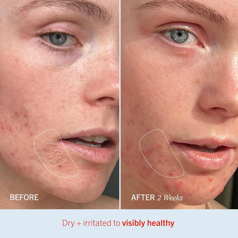 First Aid Beauty - Ultra Repair Cream, Intense Hydration Whipped Colloidal Oatmeal, Clinically Proven to Strengthen Skin Barrier in 7 Days & Helps Relieve Eczema, Luxury Moisturizer, 6 oz + Bonus, 2ct Infinity Warehouse