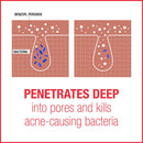 Neutrogena Stubborn Acne AM Face Treatment with 2.5% Micronized Benzoyl Peroxide Acne Medicine, Oil-Free Daily Facial Treatment to Reduce Size & Redness of Breakouts, Paraben-Free, 2 oz Neutrogena