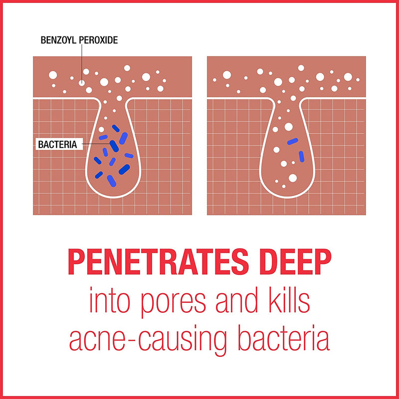 Neutrogena Stubborn Acne AM Face Treatment with 2.5% Micronized Benzoyl Peroxide Acne Medicine, Oil-Free Daily Facial Treatment to Reduce Size & Redness of Breakouts, Paraben-Free, 2 oz Neutrogena