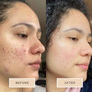 Averr Aglow Clear Skin Elixir, Face Mask Prevent Breakouts, Clear Acne & Oily Skin, Fade Scars Marks, Natural Skincare Solution, Reducer & Pores Cleanser Treatment, Natural Younger Looking Skin Averr Aglow Store