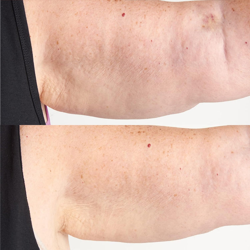 Perricone MD High Potency Hyaluronic Intensive Body Therapy, 6 fl. oz. Infinity Warehouse