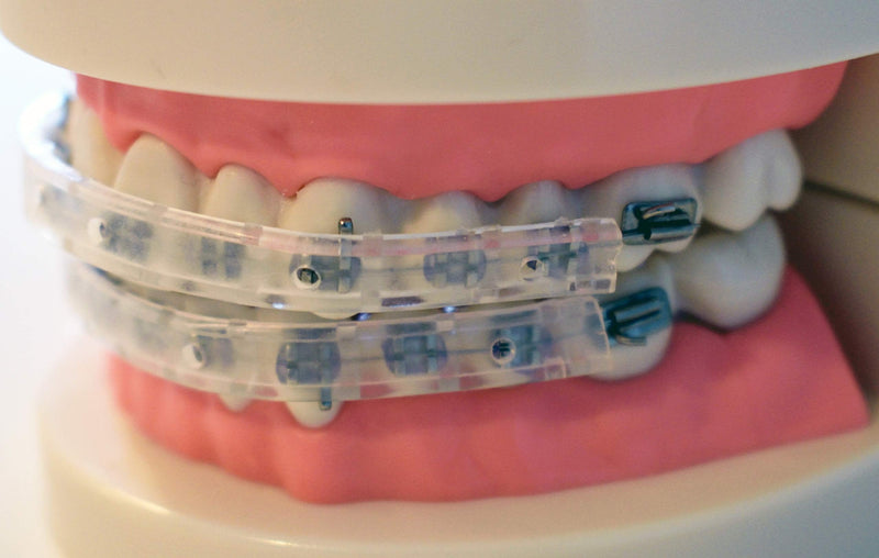 Tecnidentusa Clip-On Comfort Lip Shield/Mouth Protector Guard for Braces Dental Wax Alternative TecnidentUSA Affordable Quality Orthodontics Suppliers