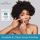 Maximum Strength Hydrocolloid Acne Remover Sticker Dots, 72 Pack | Face Healing Patch Treatment for Absorbing Zits, Pimples, Cystic Spots, Blemish | Fast Acting Tea Tree Therapy Covers All Skin Types Medical Miracles