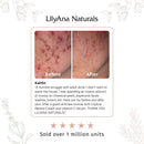 LilyAna Naturals Vitamin C Serum for Face - Made in USA, Face Serum with Hyaluronic Acid and Vitamin E, Anti Aging Serum, Reduces Age Spots and Sun Damage, Promotes Collagen and Elastin - 1oz LilyAna Naturals