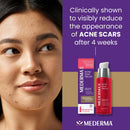Mederma Acne Scar Serum, Triple-Action Formula with Niacinamide, 1 Fl Oz Infinity Warehouse