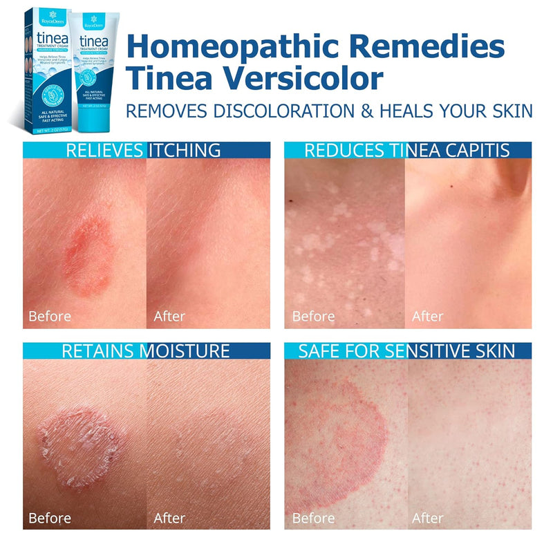 Roycederm Antifungal Essentials Duo: Tea Tree Body Wash & Tinea Treatment Cream Infinity Warehouse