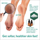 Urea Cream 40 Percent For Feet Maximum Strength Gel Softens Cracked Heel Calluses & Thick Toenails GILDEN TREE