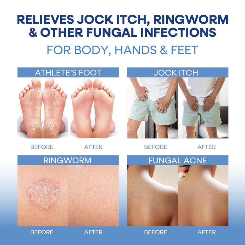 Hermon Antifungal Soap with Tea Tree Oil: Antifungal Bar Soothing Care & Relief of Itchy for Ringworm Jock Itch Tinea Versicolor Athletes Foot - Body & Face Wash for Men and Women Infinity Warehouse