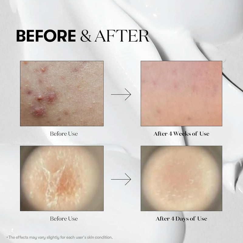 VT COSMETICS CICA Reedle Shot 50, Day&Night Mild Exosome, Microneedling Serum, Centella Asiatica, Hyaluronic Acid, Exfoliation, Soft & Glass Skin, Korean Skin Booster 1.69Fl Oz(50ml) Infinity Warehouse